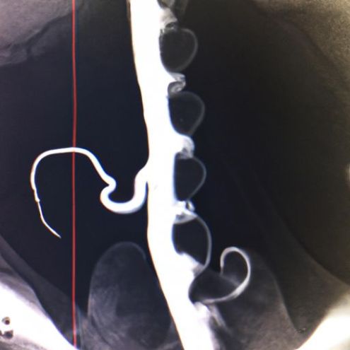 stent Tianck medical urology rich plasma double j ureteral